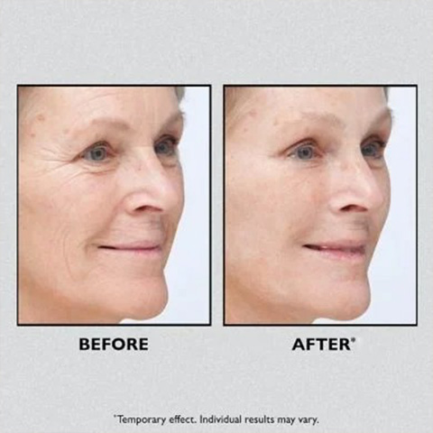 InfiniteTight®  – Lifting Facial Inmediato