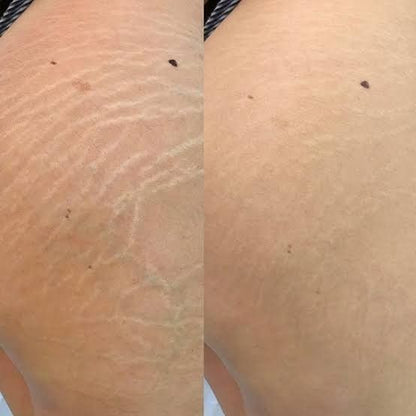 Tratamiento Anti-Estrías