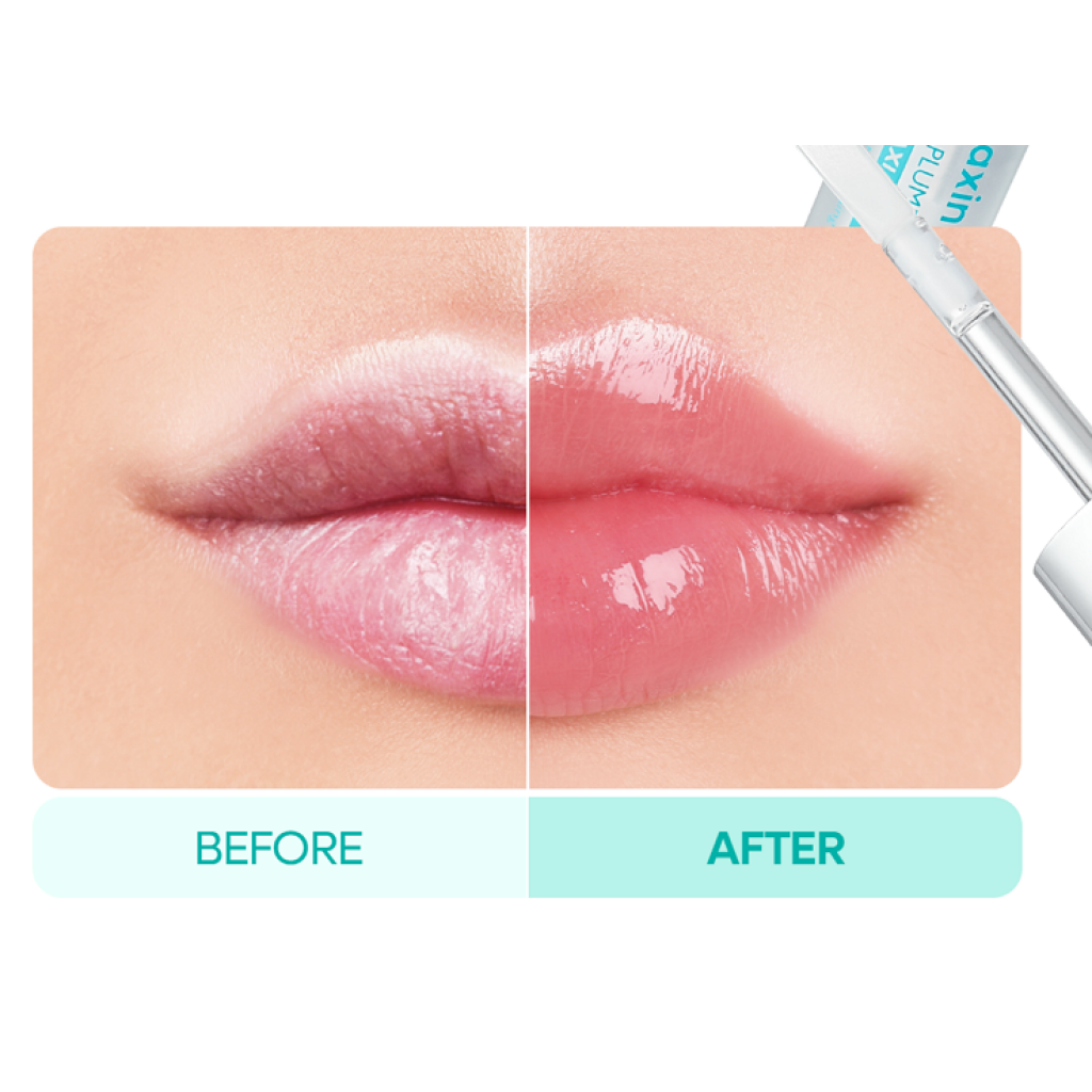 Rellenador de labios®