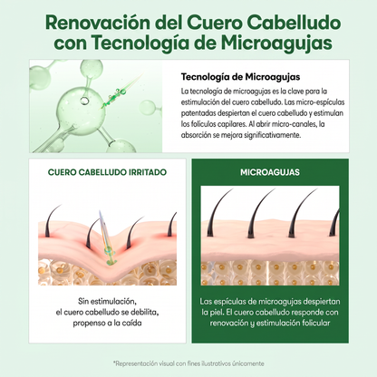 Renovación del Cuero Cabelludo con Tecnología de Microagujas