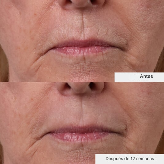 InfiniteLine – Tratamiento Antilíneas Labiales