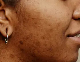 Ejemplo visual de marcas posteriores a imperfecciones