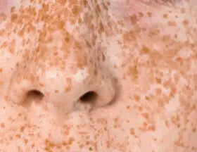 Ejemplo visual de pecas faciales
