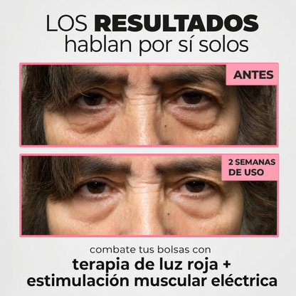 InfiniteEyes® — Terapia de Luz Roja + EMS para Eliminar Bolsas
