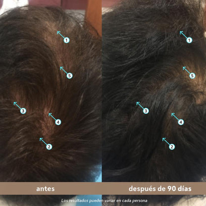 Sérum de Densidad Capilar para Hombre con Nanoxidil 5% — Anticaída 60 ml