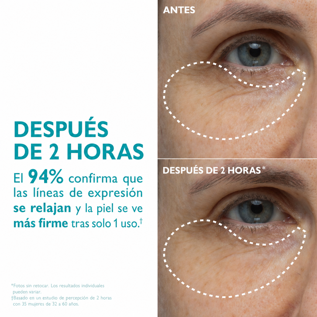 Antes y después - Contorno de ojos